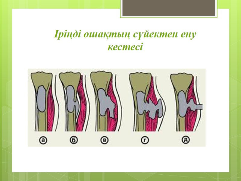 Іріңді ошақтың сүйектен ену кестесі